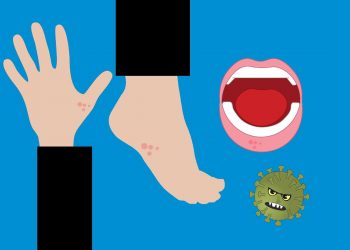 Skin Rash: New Symptom Of COVID-19 11 Image of Skin and Mouth Rash due to Coronavirus