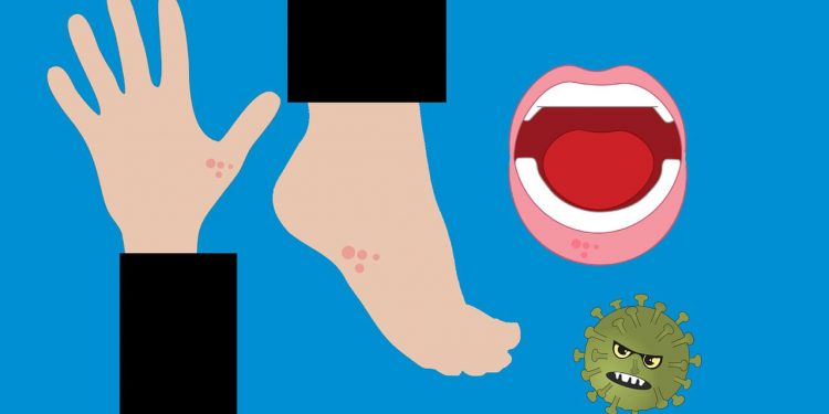 Skin Rash: New Symptom Of COVID-19 1 Image of Skin and Mouth Rash due to Coronavirus