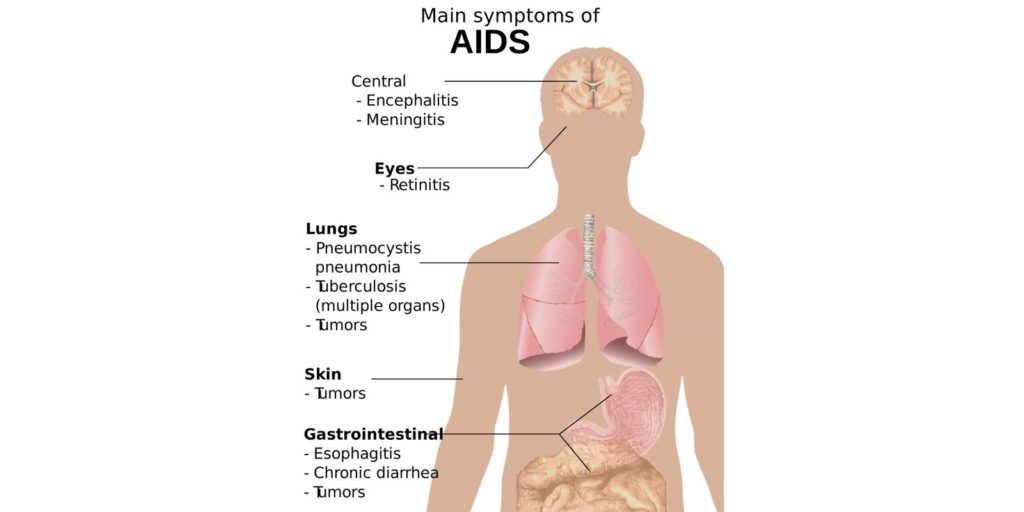 Symptoms of AIDS by Health Archives