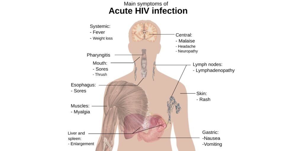 Accute HIV Infection Symptoms